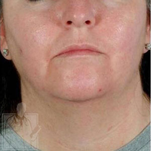 http://www.microdermabrasion.net/BeforeAfterImages/2--1-A-505.jpg
